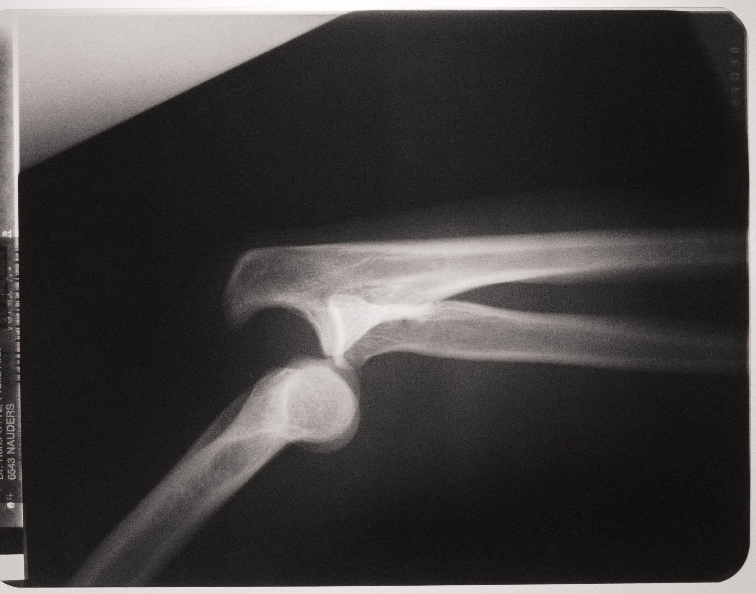 X Ray Dislocated Arm Joints St Interview