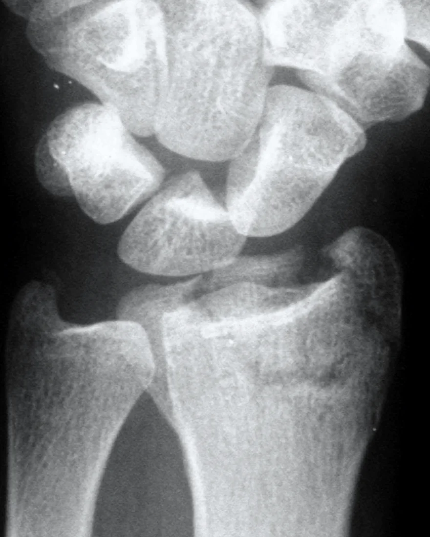 PA radiograph of a distal radius fracture