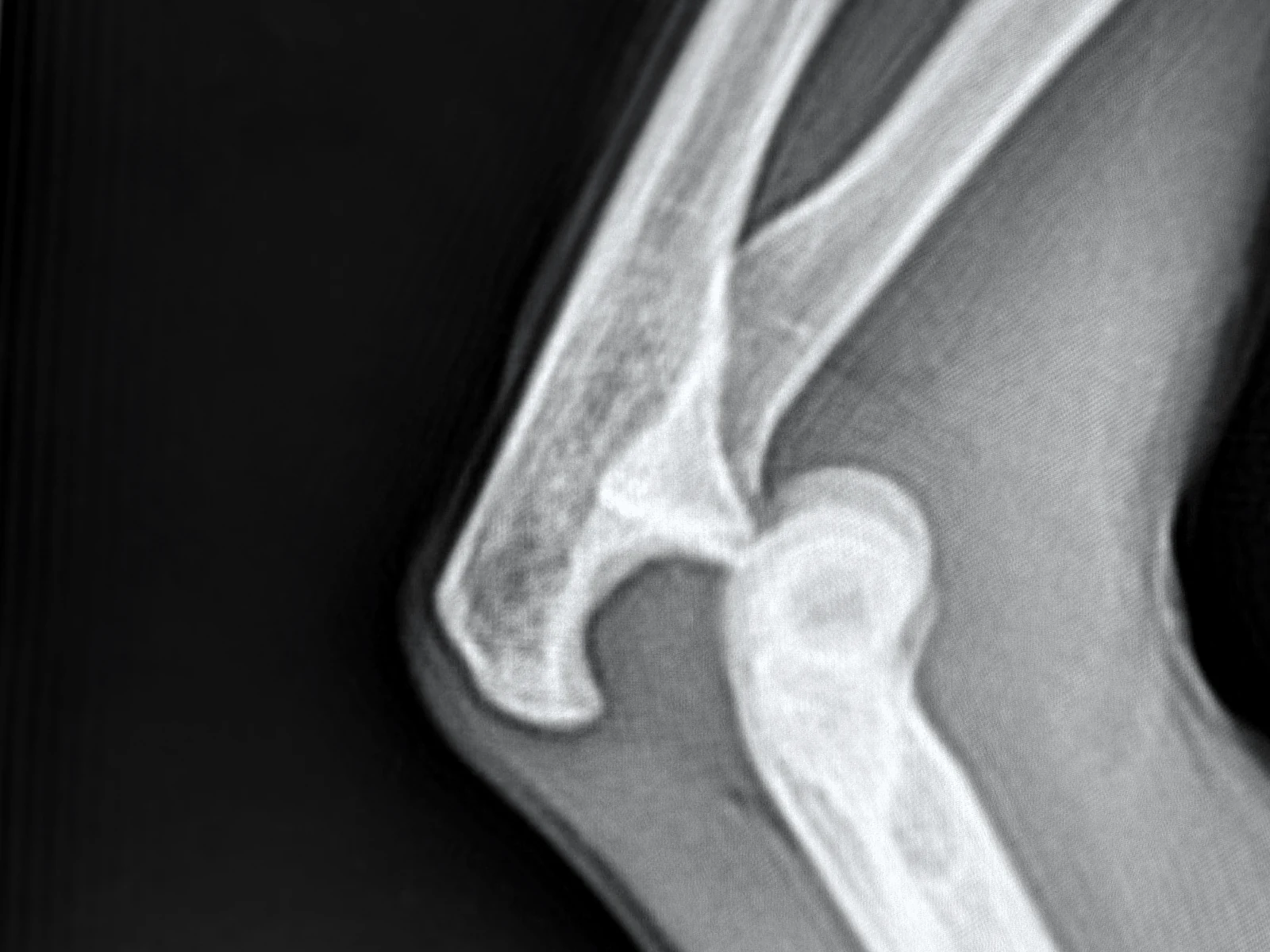 Lateral radiograph of a dislocated elbow