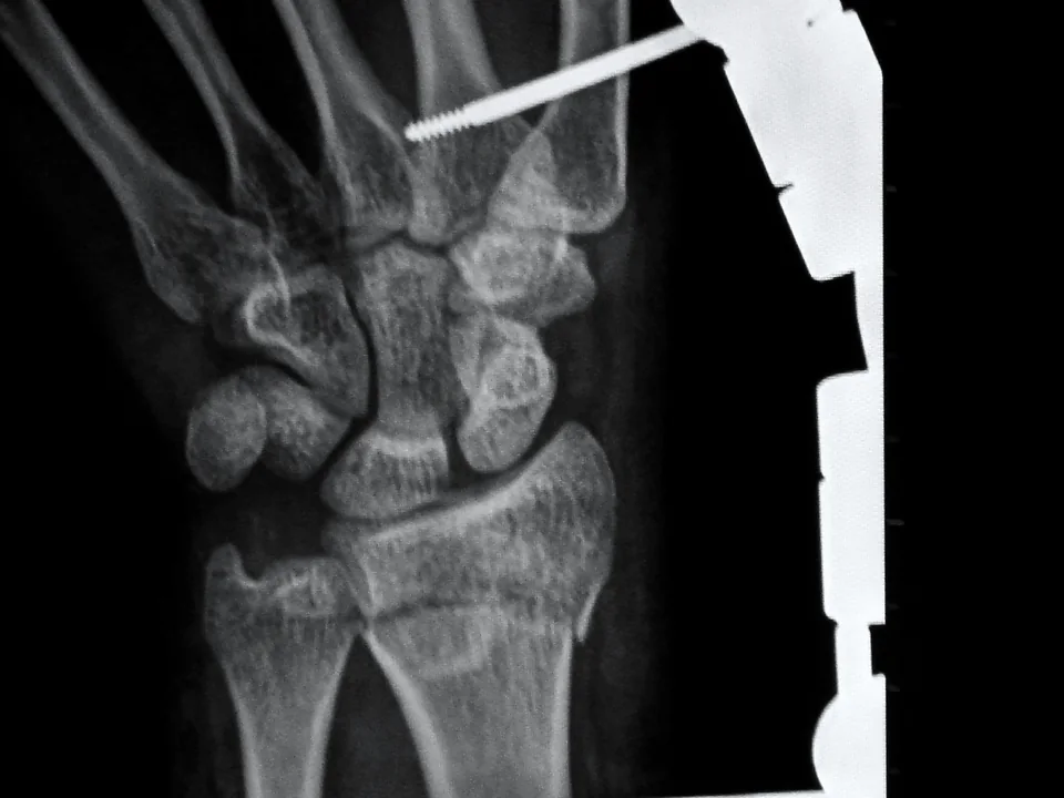 Wrist · external fixator