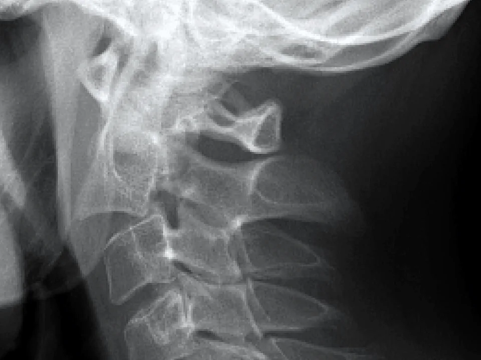C-spine · lateral