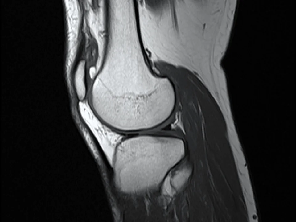 Knee MRI · sagittal T1