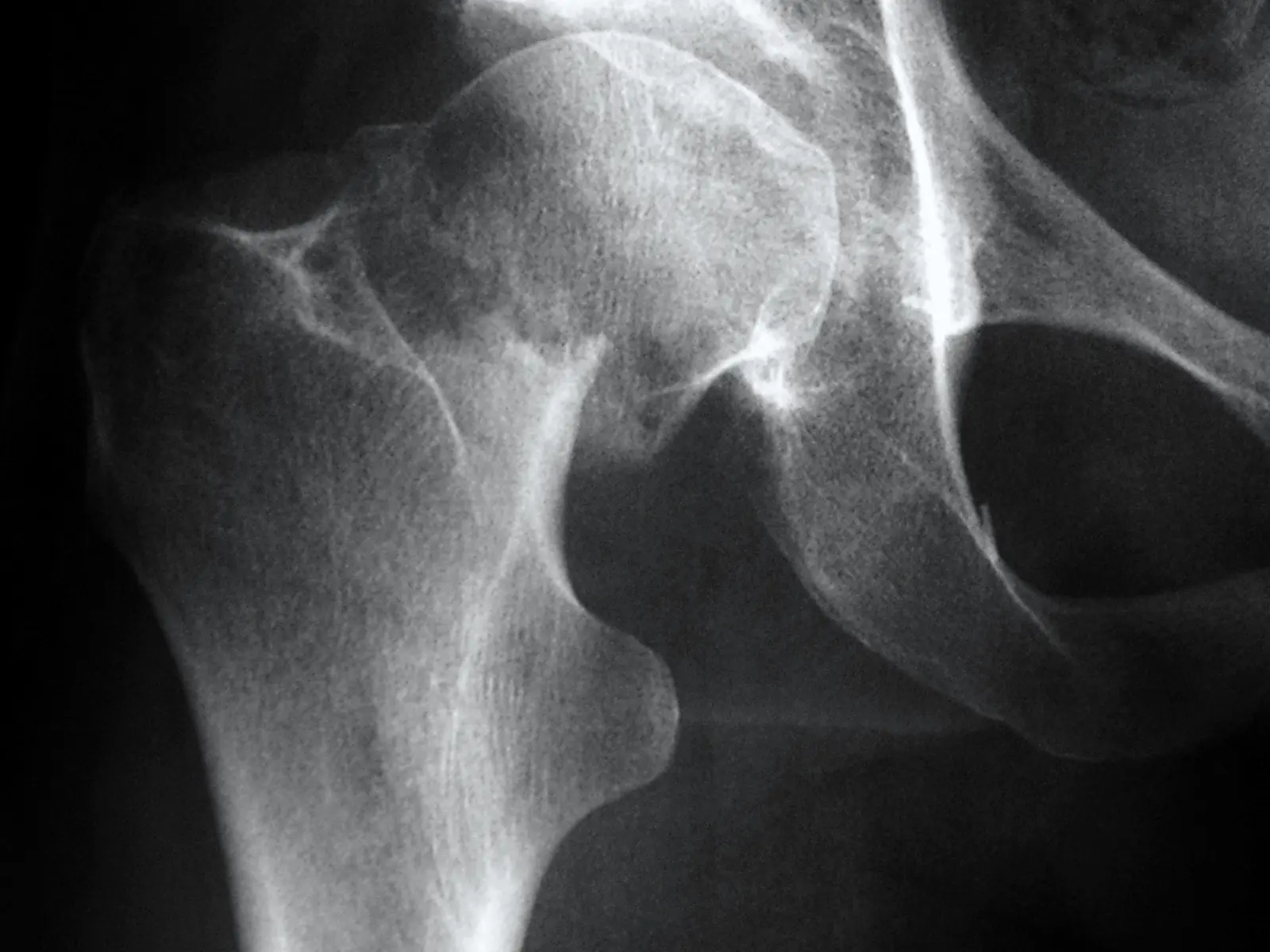 Radiograph of a fractured neck of femur