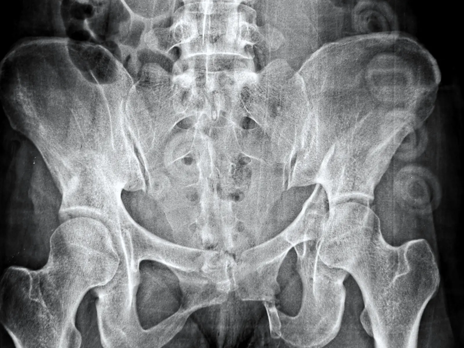 Outlet view radiograph of a pelvic fracture