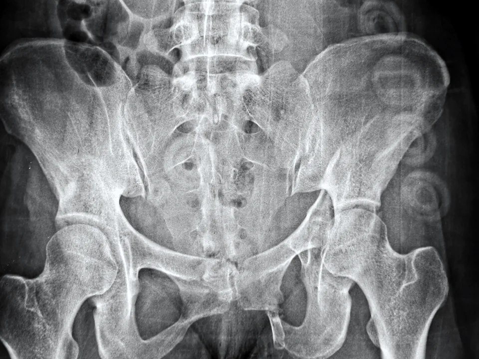 Pelvis · outlet view