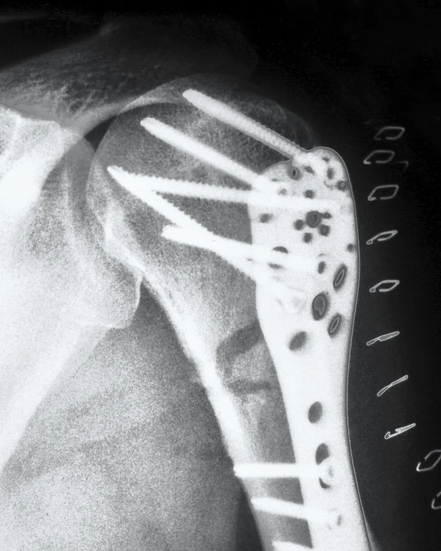Shoulder · AP