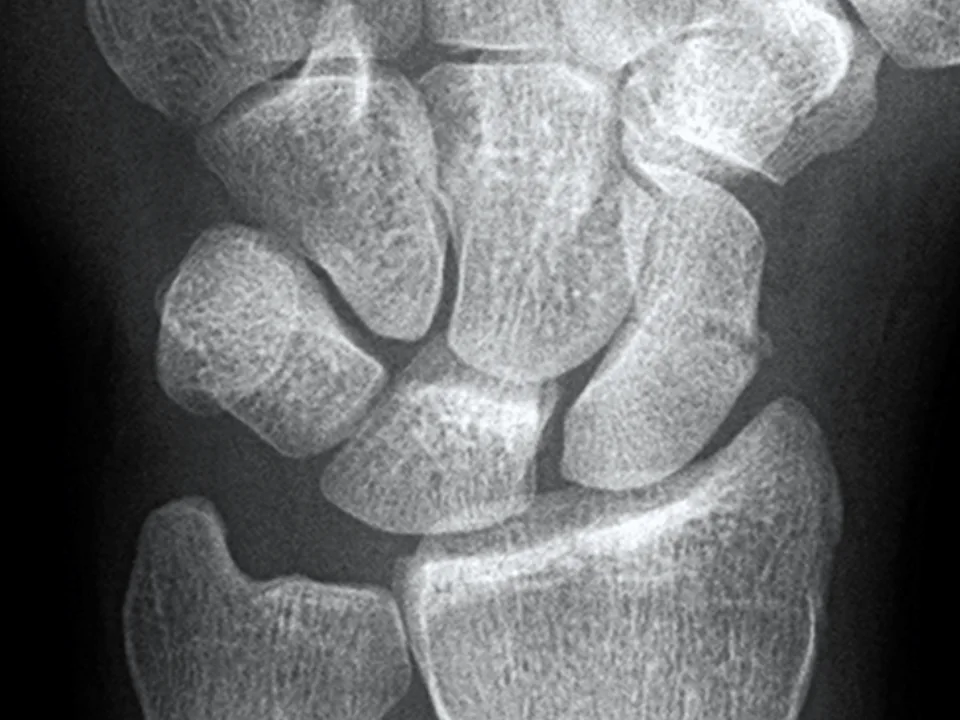 Wrist · scaphoid view