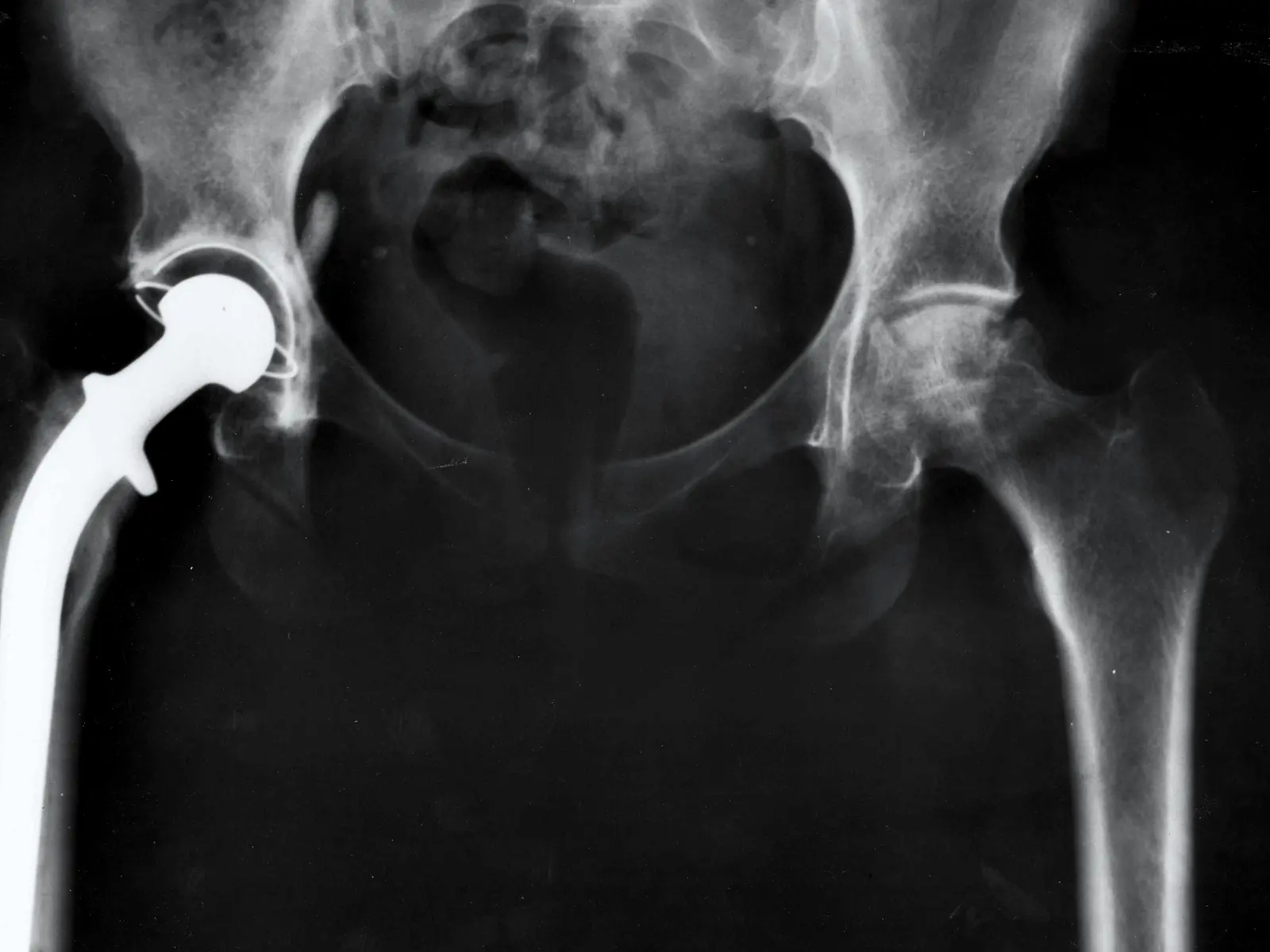 Radiograph of a hip replacement