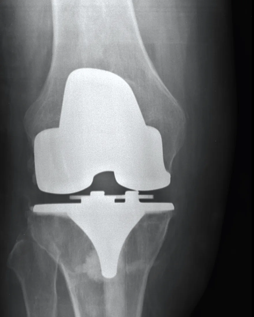 Knee replacement · AP